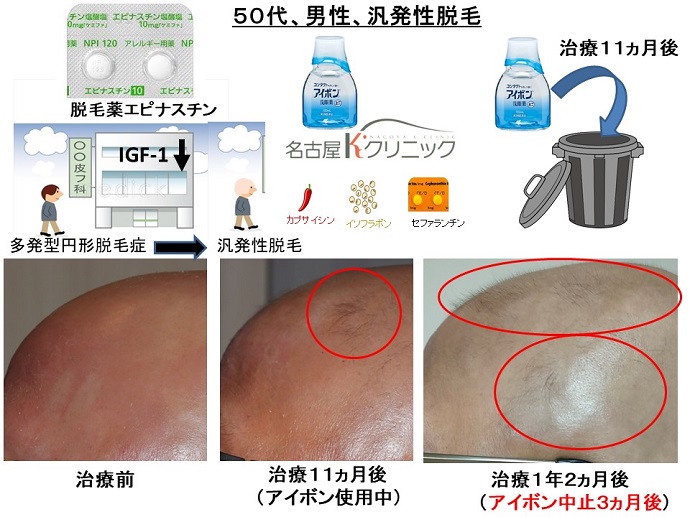 円形脱毛症　病院